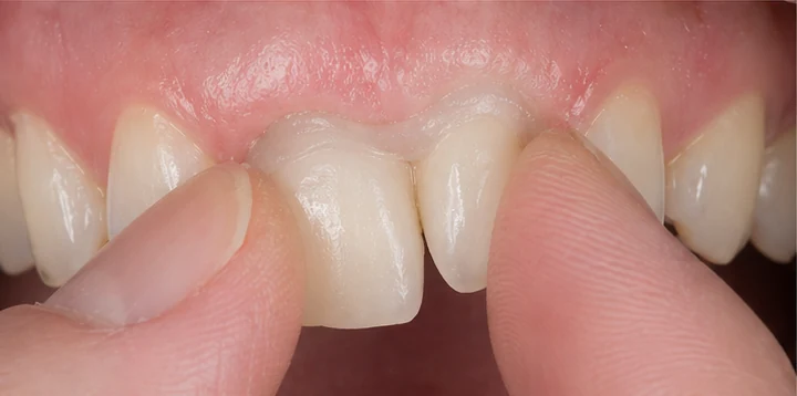 Procedimiento visual para la colocación y el ajuste de la prótesis: premolar inferior