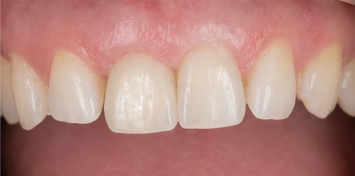 Procedimiento visual para la colocación y el ajuste de la prótesis: premolar inferior