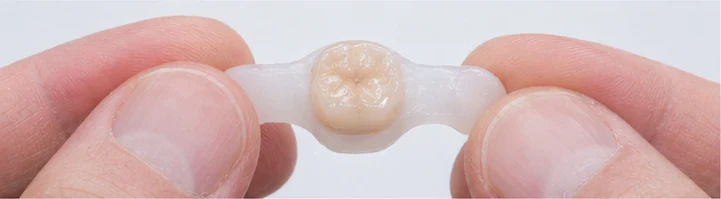 Guía visual: muela inferior ausente con dientes adyacentes
