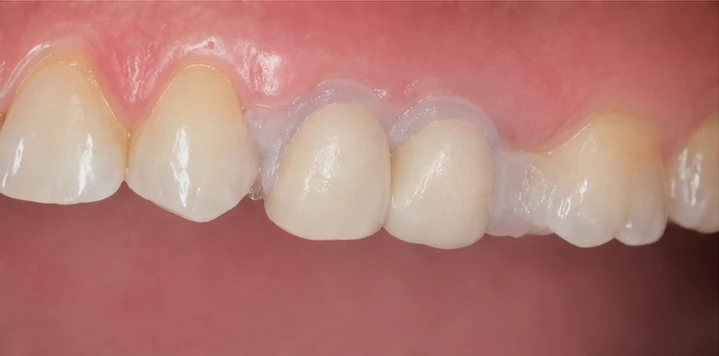 Procedimiento visual de colocación y ajuste de la prótesis: diente del ojo superior y premolar