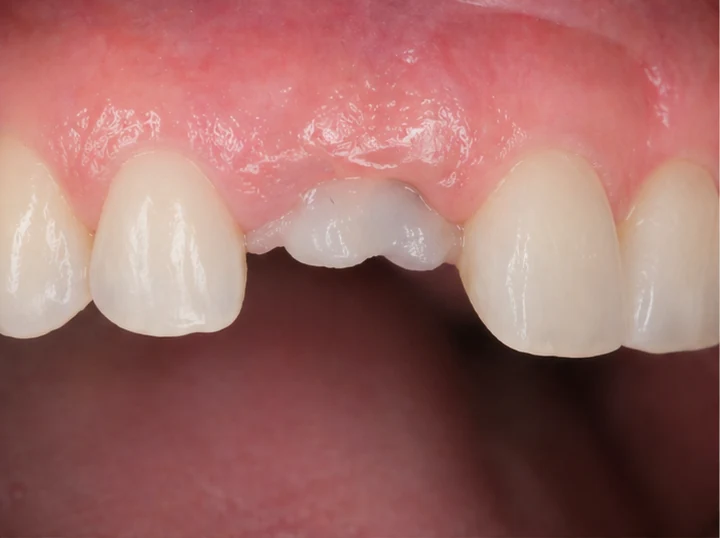 Proceso visual de colocación y ajuste de la prótesis: premolar superior