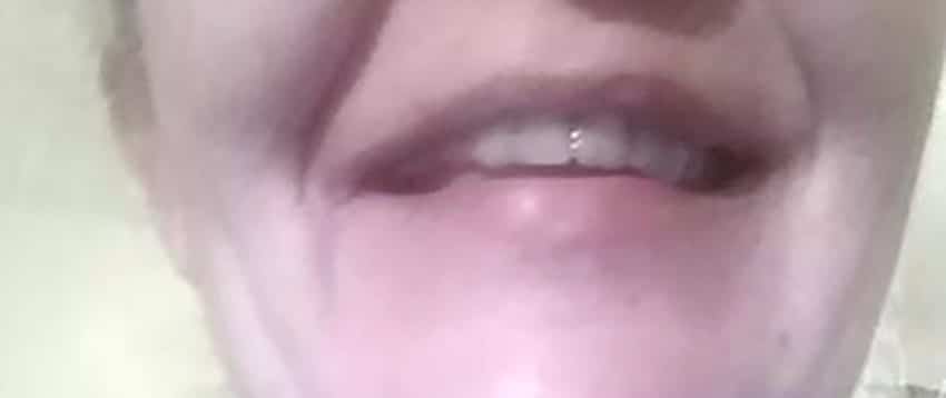 Cliente: diente delantero restaurado con Denticor