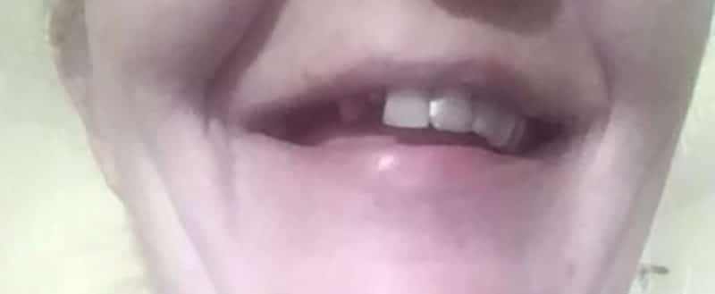 Cliente: diente delantero roto, antes de la colocación de Denticor