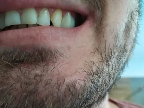 Diente lateral completado con un recambio Denticor, vista lateral