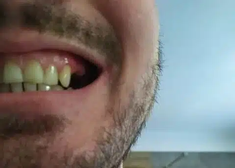 Diente lateral faltante antes de utilizar Denticor, vista lateral