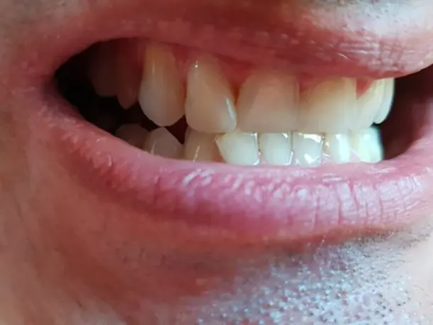 Dientes frontales sustituidos por una prótesis provisional Denticor