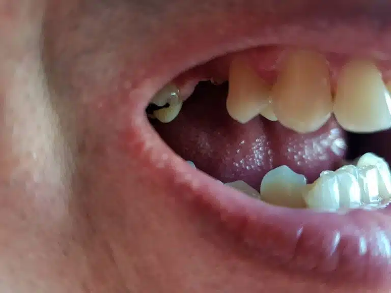 Más dientes frontales ausentes antes de colocar la prótesis Denticor