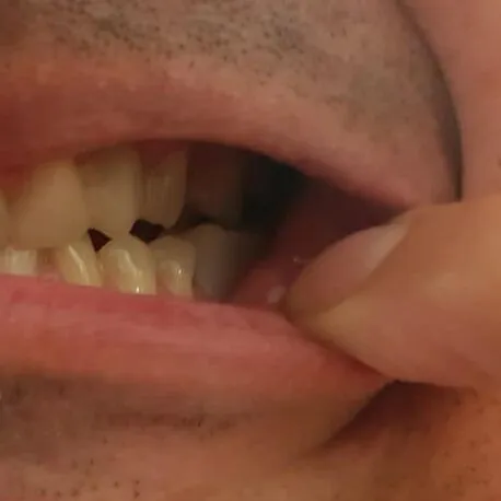 Cliente: diente inferior restaurado con Denticor