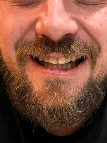 Sonrisa completa tras la reposición del diente anterior con un sustituto Denticor