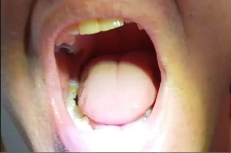 Cliente: diente lateral restaurado con Denticor