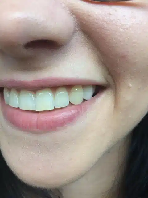 Sonrisa tras la colocación de un nuevo diente a medida de Denticor