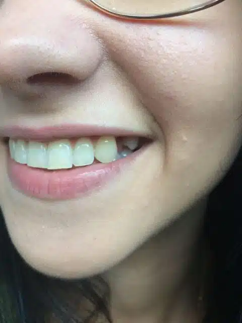 Diente delantero que falta antes de colocar la prótesis dental provisional Denticor