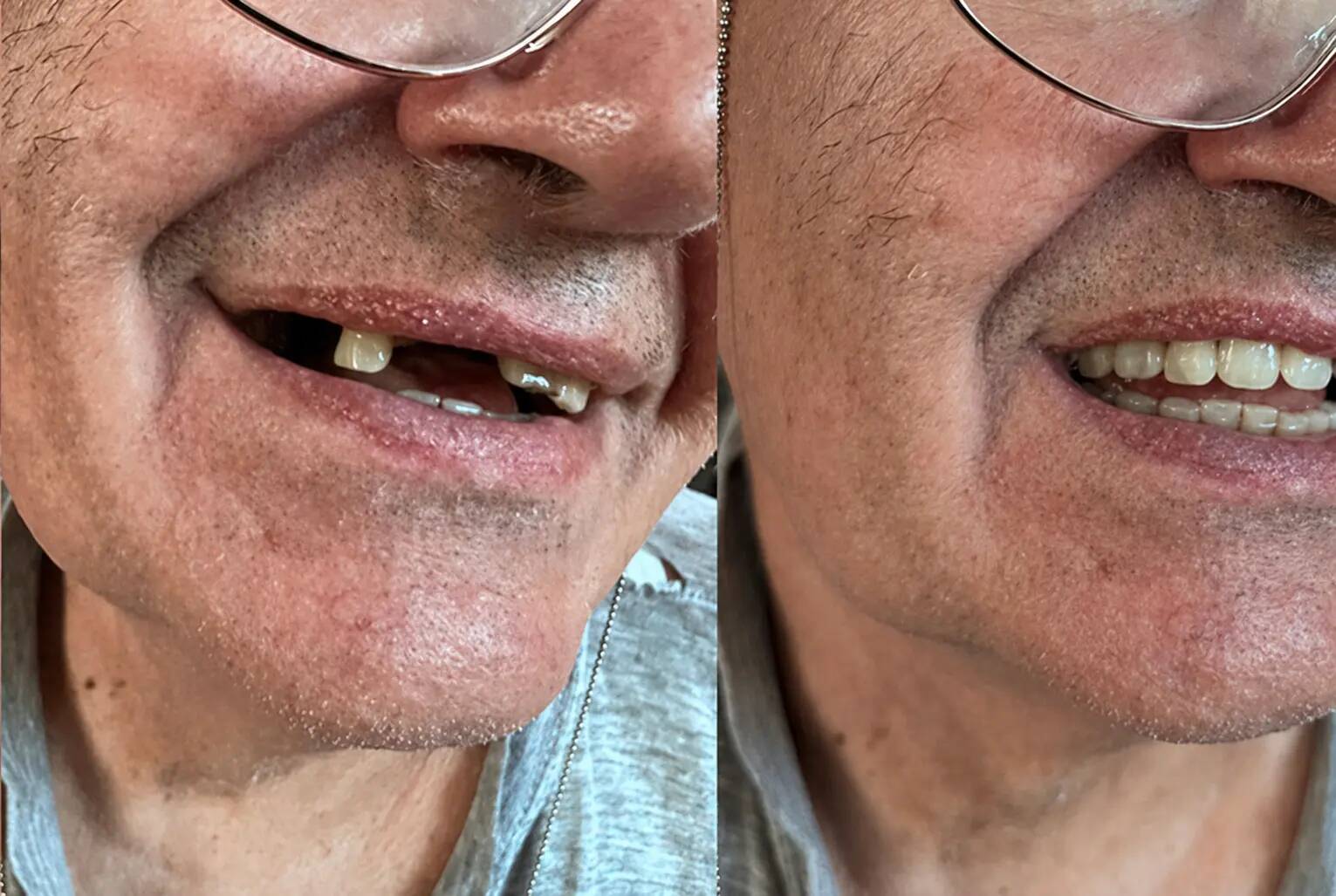 Cliente: varios dientes faltantes antes y después de Denticor